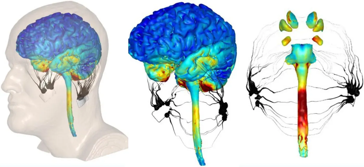 Finite element model views of NuCalm's effect on the brain: a head model, the brain, and the brain stem with the vagus nerve, colored red for maximum intensity, green for mid intensity and blue for limited intensity